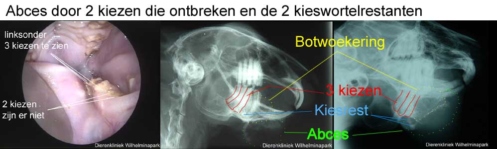 kiesresten in de onderkaak veroorzaken een abces